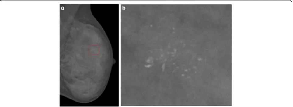 Fig. 1 Mammogram with a microcalcification cluster. a Original image. b Enlarged view of the microcalcification part of a outlined with ared rectangle