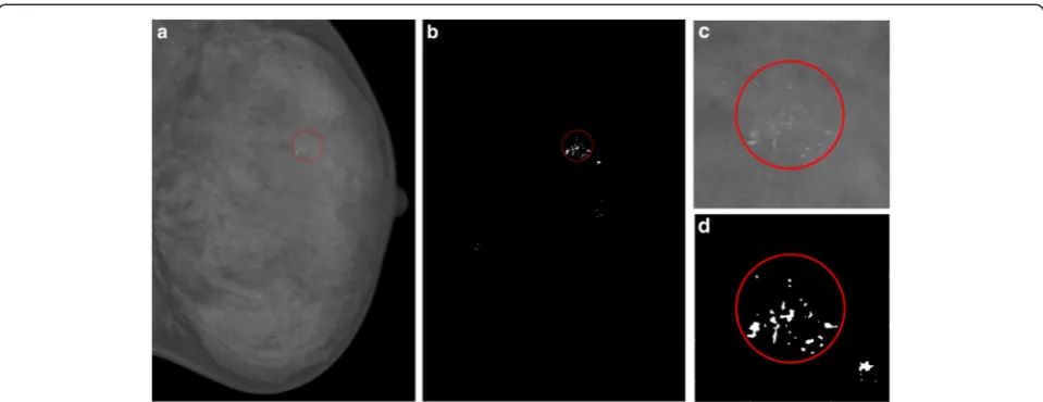 Fig. 4 Segmentation of suspected of MC.Enlarged part of the MC cluster in a Original image; the red circle is the annotation of MC cluster