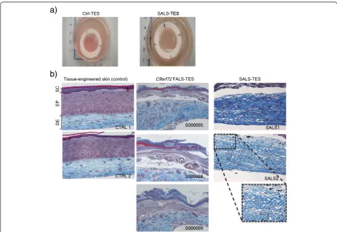 Figure 1 Structural abnormalities detected in ALS-derived tissue engineered skins. a)blue and epidermis (EP) in purple, revealed a number of structural abnormalities including undifferentiated epidermis, abnormal dermo-epidermaljunctions, delamination, abn
