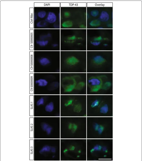 Figure 2 Cytoplasmic TDP-43 accumulation detected in SALS- and C9orf72 FALS-derived tissue-engineered skins
