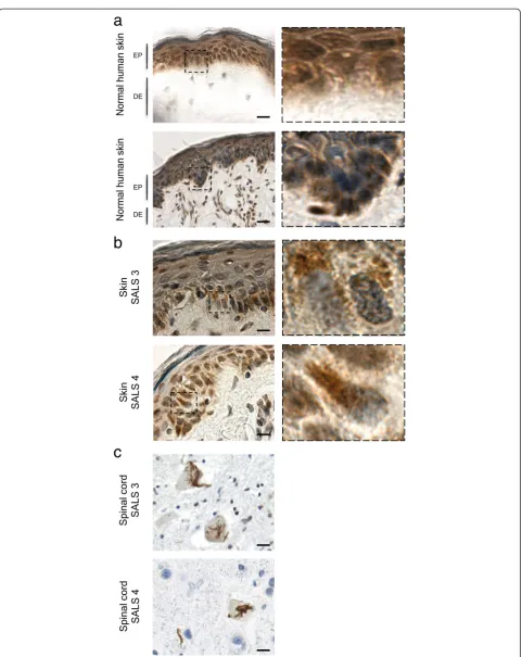 Figure 5 Cytoplasmic TDP-43 detection in native skin biopsies and corresponding CNS tissues in SALS patients