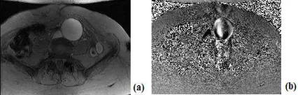 Figure 3.  Amplitude Image (A) And Phase Contrast 