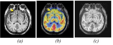 Figure 9:Simulation Results. (a) MRI brain Image, (b) PET brain Image, and (c) Fused brain Image 