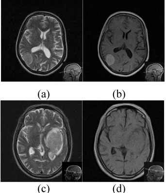 Figure 6: Tumor Region Intensity Characteristics, 