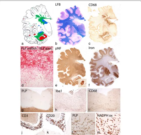 Fig. 1 Basic Pathology of HAE:and B-cells (CD20, Fig. 1products; a: Topographical distribution of demyelinated lesions in the brain shows the prominent periventriculardemyelination with peri-venous extensions (Dawson Fingers) and demyelinated plaques in th