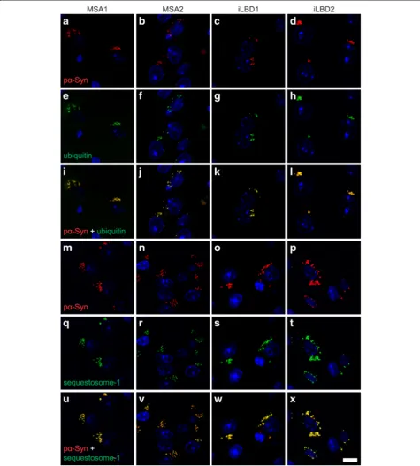 Fig. 7 Phosphorylated alpha-synuclein in inclusion bodies colocalizes with ubiquitin and sequestosome-1