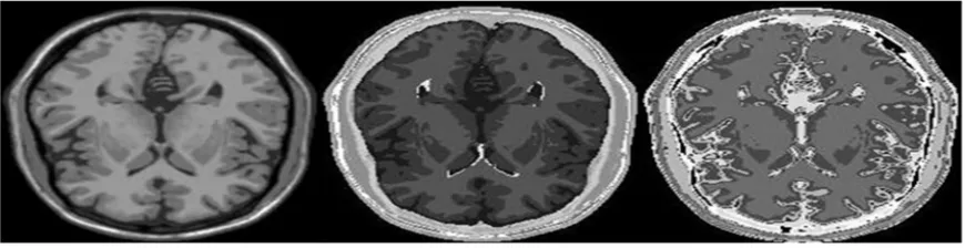 Fig. 4a. From Left To Right, Original Normal MRI T1 Image In Z1, Ground Truth Normal MRI T1 Image In Z1, And Normal MRI T1 Image In Z1 Segmented By FFCM
