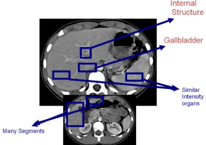 Figure 1. A Sample CT Scan Of The Abdominal Area Showing Some Challenges Of Liver Segmentation