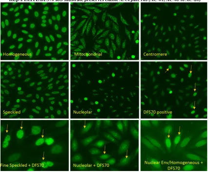 Fig. 6 Shows examples of homogeneous, mitochondrial, centromere,HEp-2 cell nuclei intensely stained with DFS70 reactive serum