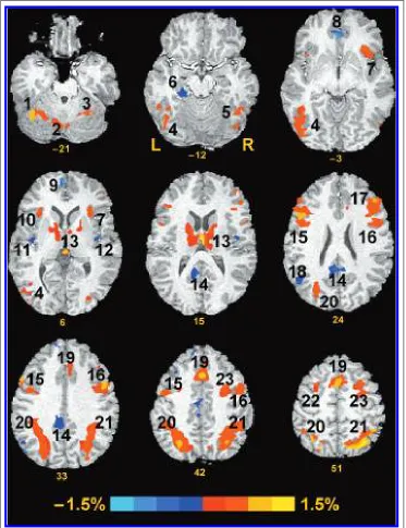 Figure 1. Regions showingmm (inferior) to 51 mm(superior). Red and yellowclusters show increasedactivation during RVIP taskperformance, blue clustersindicate deactivation (see colorscale)