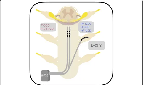 Fig. 1 Lead Placement in P-SCS and PF-SCS: Dorsal column stimulation with traditional P-SCS, B-SCS and HF-SCS are anatomically placed over thedorsal columns