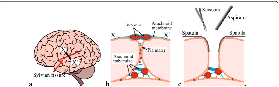Fig. 1 Schematic of the opening of a Sylvian fissure. a Sylvian fissure, b cross-sectional view of X-X′, and c retraction and dissection using spatulas, scissors, and an aspirator