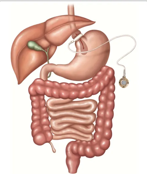 Figure 2 AGB: Adjustable gastric band. A band with an inner inflatable silastic balloon is placed around the proximal stomach just belowthe gastroesophageal junction