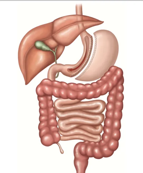 Figure 3 SG: Sleeve gastrectomy. The stomach is transected vertically creating a gastric tube and leaving a pouch of 100 to 200 mL