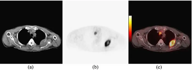 Fig 4. a CT, b PET, and c PET/CT fused image of a patient having EPTB.