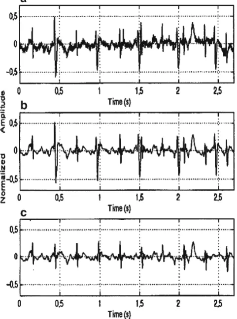 Fig. 2. a Abdominal ECG; b signal after the wavelet analysis stage; cextracted fetal QRS (55).