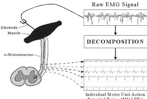 Fig. 1: EMG signal and decomposition of MUAPs. 