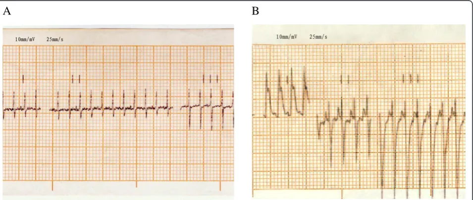Figure 1 The electrocardiogram of the rats. A: Electrocardiogram in the normal rat. B: ST-segment elevation in leads I in myocardial ischemiarat.