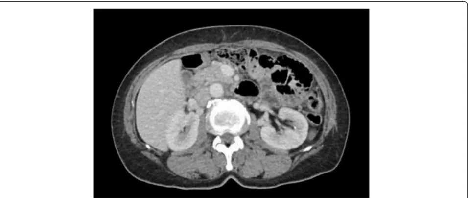 Fig. 4 Follow-up CT in 18 months later showed marked regression of pancreatic desmoid tumor under celecoxib treatment