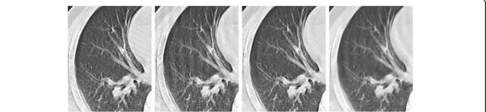 Fig. 6 Comparison of reconstructed images of local details amplification with different reconstruction methods (SNR = 40 dB)