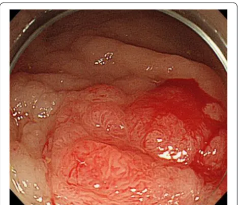 Fig. 1 Intramucosal adenocarcinoma on the right anastomosissite of the ureterosigmoidostomy