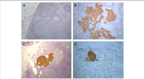 Figure 2 Immunohistochemistry staining for cytokeratins (M3515, clone AE1/AE3, Dako) in histologically negative lymph nodes of HNSCCpatients