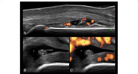 Figure 1 Early arthritis. The longitudinal dorsal scan of the II metacarpophalangeal joint (A) shows a wide spectrum of inflammatoryfindings, such as joint cavity widening, fluid collection (°), synovial hypertrophy (*) and multiple power Doppler spots (+)