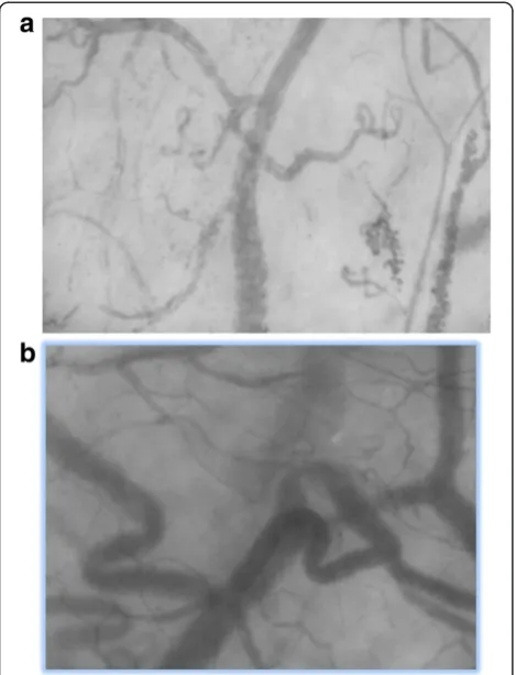 Figure 2 Side-stream darkfield imaging (SDF) in dengue.late febrile phase, showing reduced total vessel density andperfused vessel density, plus extravasated red cells in the left upperand lower quadrants;Example of still SDF images from (a) a patient with dengue in the (b) the same patient in the recovery phasewith normal vessel density, flow rate and perfusion indices.