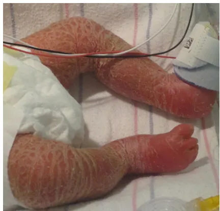 Figure 2 Neonate with Netherton syndrome.Note: Skin is diffusely erythematous with fine scaling.
