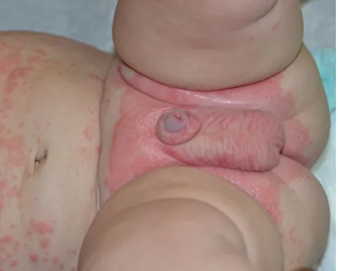 Figure 3 Psoriasis in infants often localizes to the diaper area.Note: Periumbilical involvement is also common
