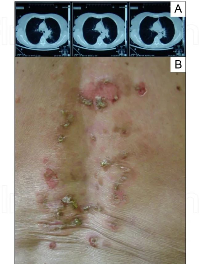 Figure 1. A. Chest CT of an elderly PV patient showing tumor in the left lung. B. Aggravation of mucocutaneous PV after palliative radiotherapy (radiotherapy-induced PV lesions).