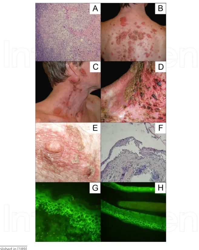 Figure 2. A. Carcinoma planoepitheliale keratodes invasivum in lymphoid tissue. H+E staining