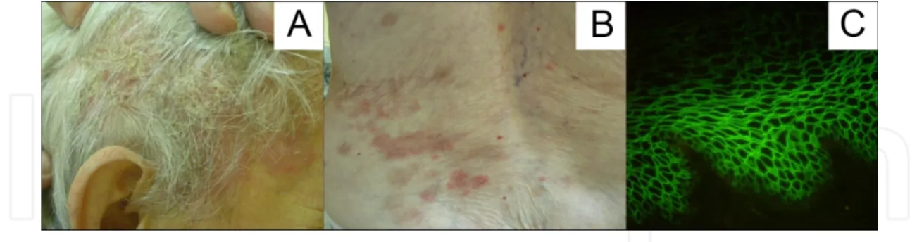 Figure 3. A. Erythematous plaques and crusts on the scalp of the head. B. Erosions and blisters on the back