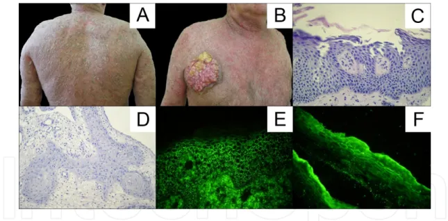 Figure 4. A. Disseminated erythematous plaques and crusts on the back. B. Exophytic tumor on anterior surface of the chest