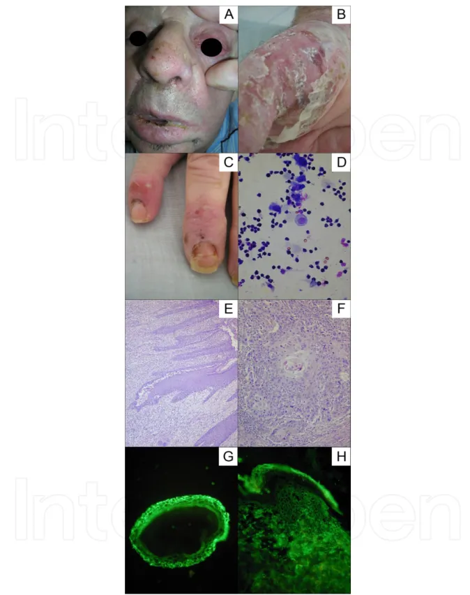 Figure 5. A. Mucosal erosions in patient with lower lip SCC and mucocutaneous PV. B. Fragile blister on the hand