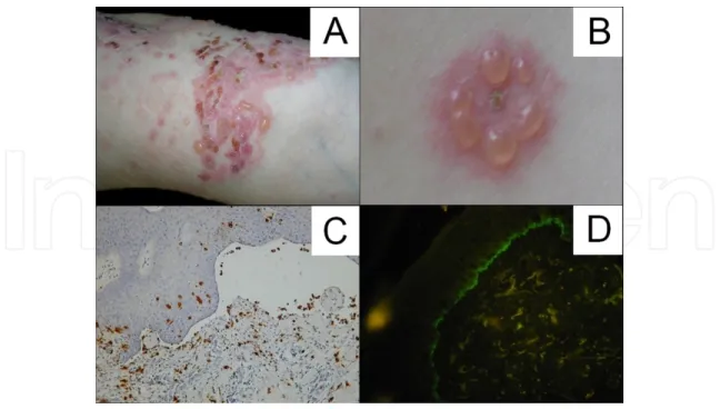 Figure 9. A. Erosions and bullae on erythematous skin forming “string of beans”. B. Group of small blisters forming