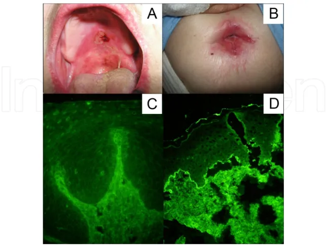 Figure 10. A. Mucosal erosions in oral cavity. B. Erosion in the navel. C. IIF study revealing no IgG antibodies binding either desmosomal proteins of keratinocytes or basement membrane antigens