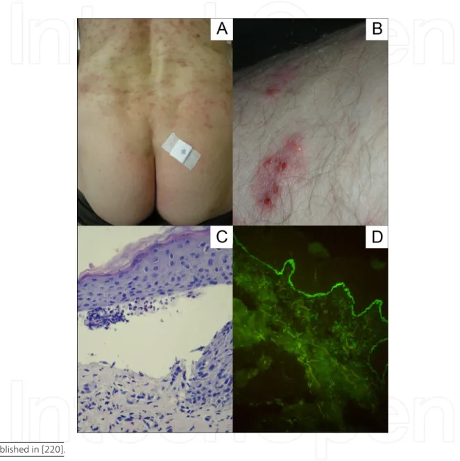 Figure 11. A. Erythemous/oedematous lesions and erosions on the back in patient with vesiculous form of BP