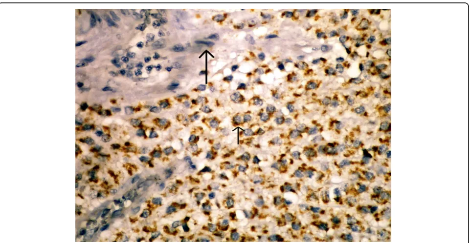 Figure 2 Positive staining in tumor cell’s cytoplasm for maspin (short arrow) but not stain in endothelial cells (long arrow)