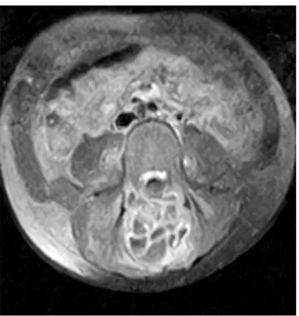 Figure 5. T1 axial sequence with Gado showing a heterogeneous enhancement of soft tissue flooding