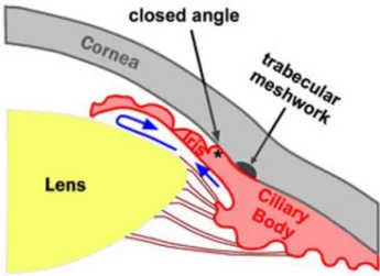Figure 3: Schematic diagram Primary Angle Closure Glaucoma  Source: Stepwards, Open-angle Glaucoma 