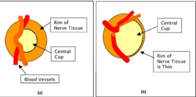 Figure 9: Anatomy of (a) normal optic disc and (b) optic disc with glaucoma damage  Source: Craig Blackwell MD, Testing for Glaucoma 