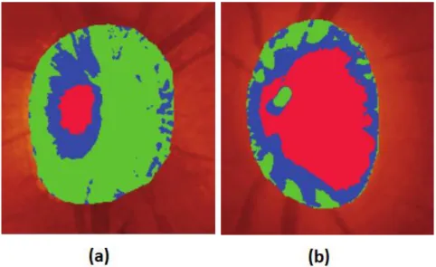 Figure 10: Optic disc captured by HRT (a) normal optic disc (b) optic disc with “cupping” 