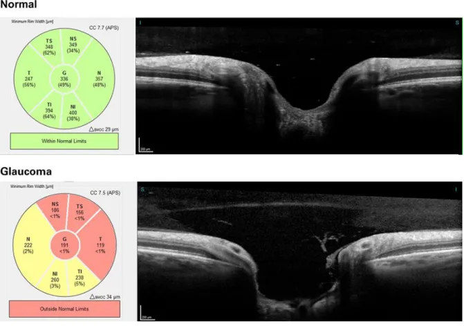 Figure 11: Comparison of a normal vs glaucoma on OCT  Source: Heidelberg Engineering, What is an OCT examination? 