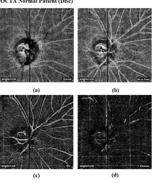 Figure 12: OCTA disc images of non-glaucoma patients  