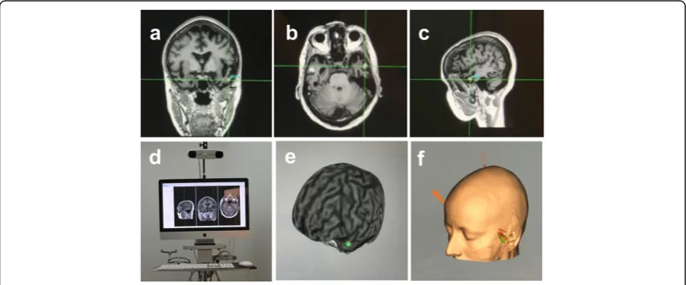 Fig. 2 The three upper panels show, respectively, a coronal, b axial and c sagittal sections from magnetic resonance imaging (MRI) in arepresentative patient with semantic dementia (SD)