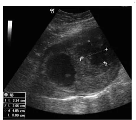 Figure 1 Abdominal ultrasonography revealed a large massmeasuring 12.85 × 10.52-cm with mixed echogenicity,occupying the pelvis and extending above the pubicsymphysis; two cystic areas within the mass measuringapproximately 4.30 × 4.97-cm and 3.54 × 3.66-cm are noted.