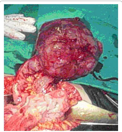 Figure 4 Demonstration of the resection of segmental bowel;the tumor was removed with a part of 3-cm of the smallintestine.