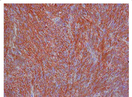 Figure 9 Immunohistochemical staining of the tumor tissuedemonstrated strongly positive reactivity to CD34 in almost allthe tumor cells.