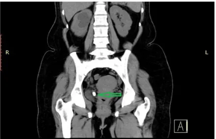 Figure 1. X-Ray KUB showing right lower ureteric calculus. 
